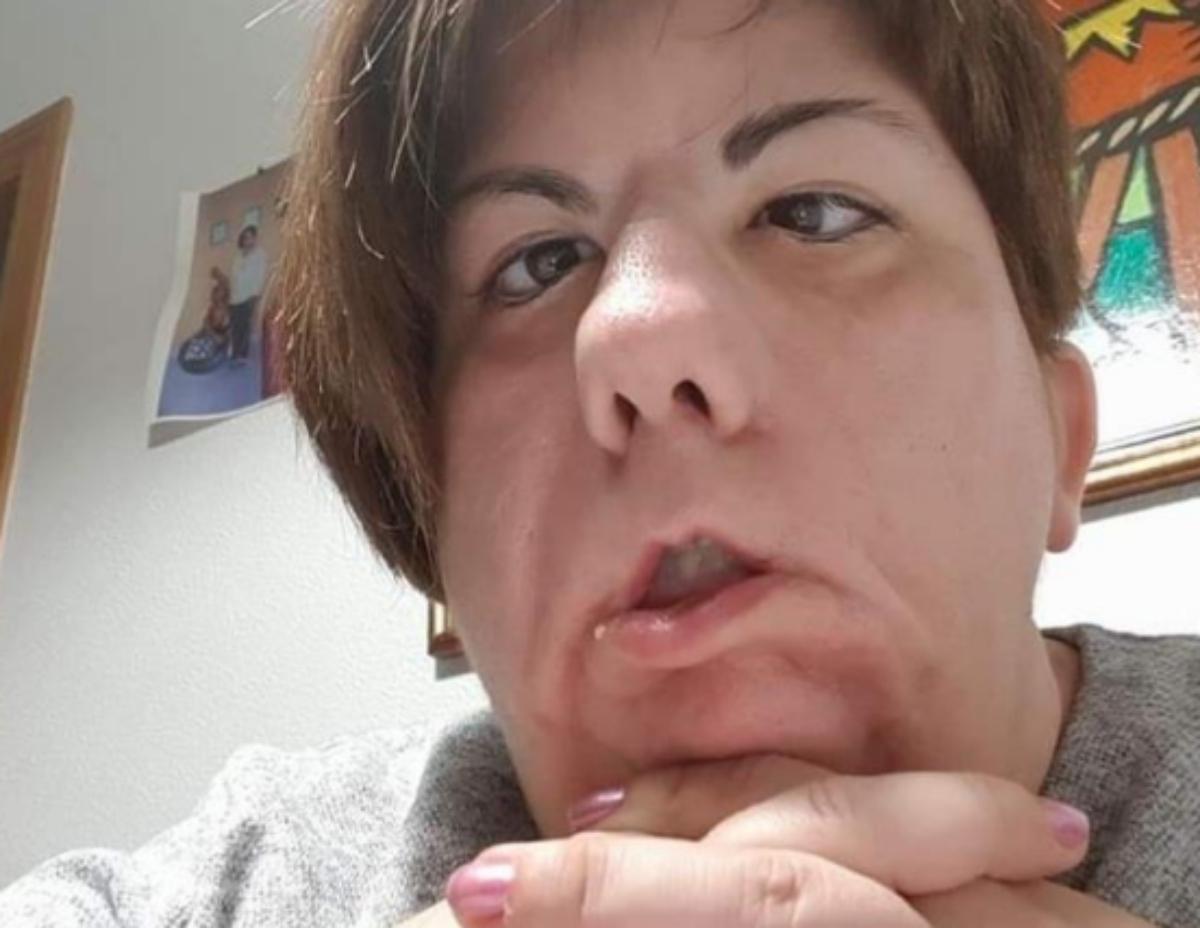 Yolanda Fernández, afectada con el síndrome de Moeibius