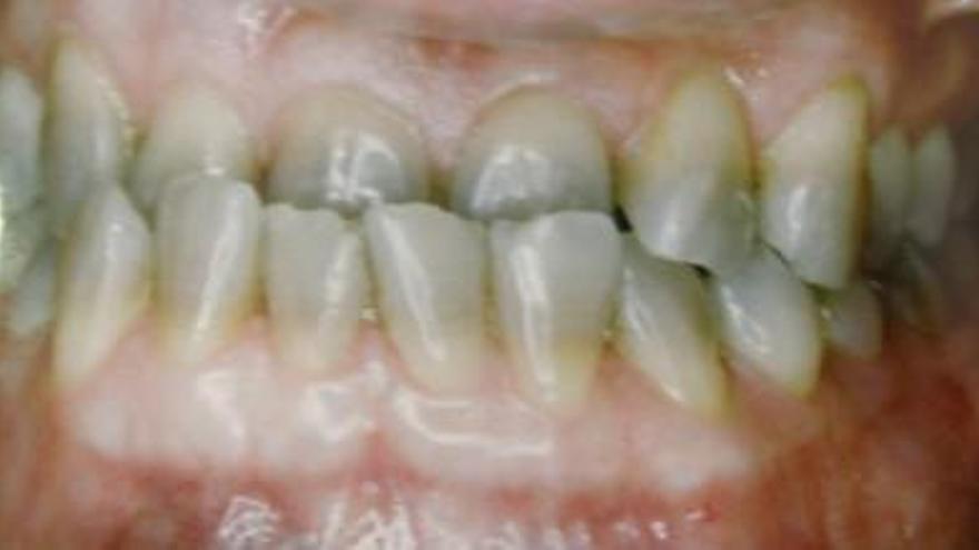 Los efectos devastadores de las bebidas energéticas en los dientes