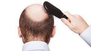 Imagen de archivo sobre la alopecia.