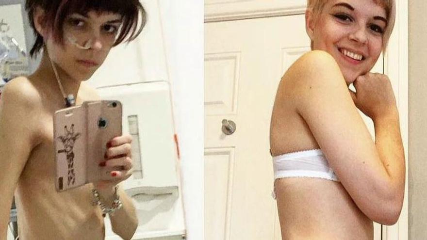 Una joven británica muestra al mundo su recuperación tras 10 años de lucha contra la anorexia