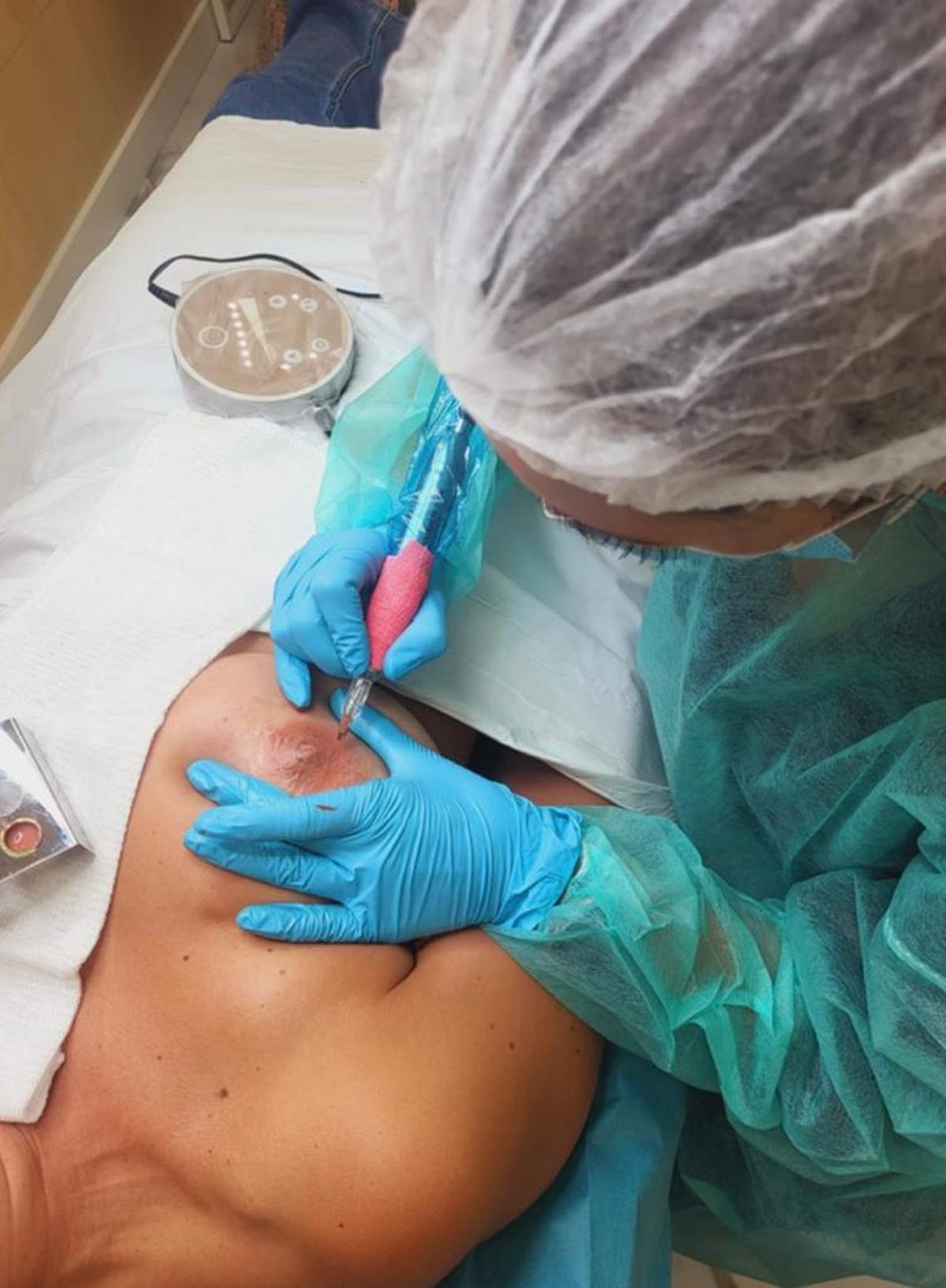 Tarea de micropigmentación del pecho de una paciente