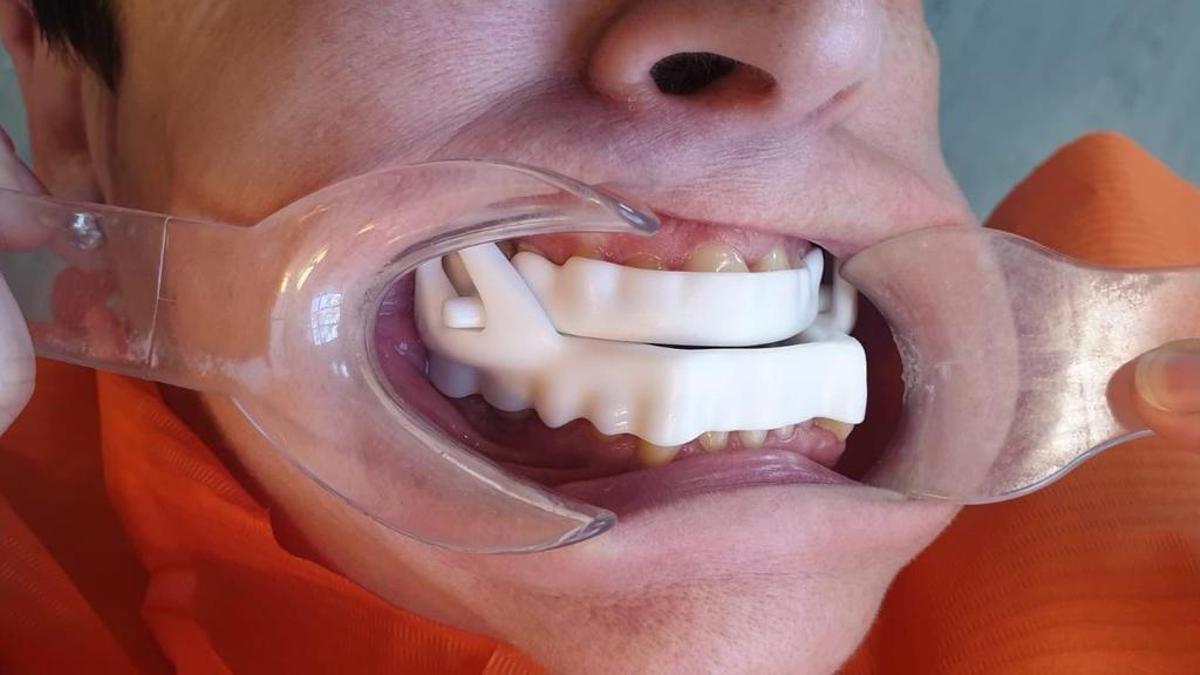 Dispositivos de avance mandibular, una solución conservadora, no invasiva y reversible.