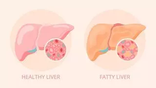 Hígado graso no alcohólico: Al fin llega un fármaco (Resmetirom) para tratar la silenciosa esteatosis hepática metabólica