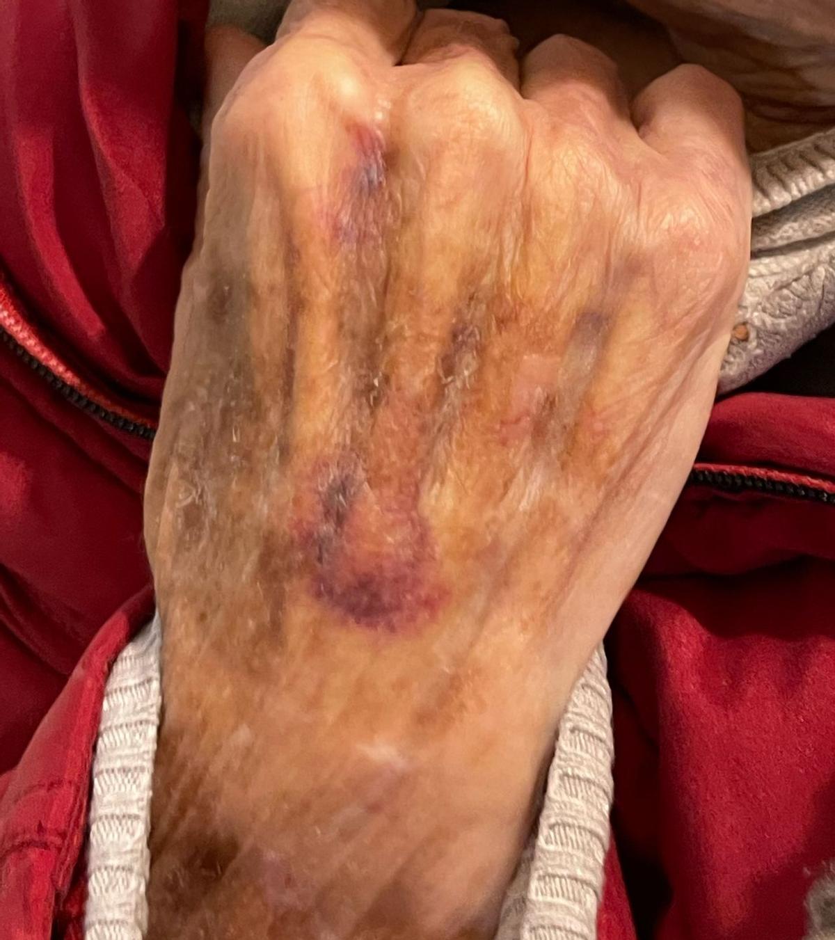 Lesiones en una mano de la anciana que está interna en la residencia de Can Carbonell.