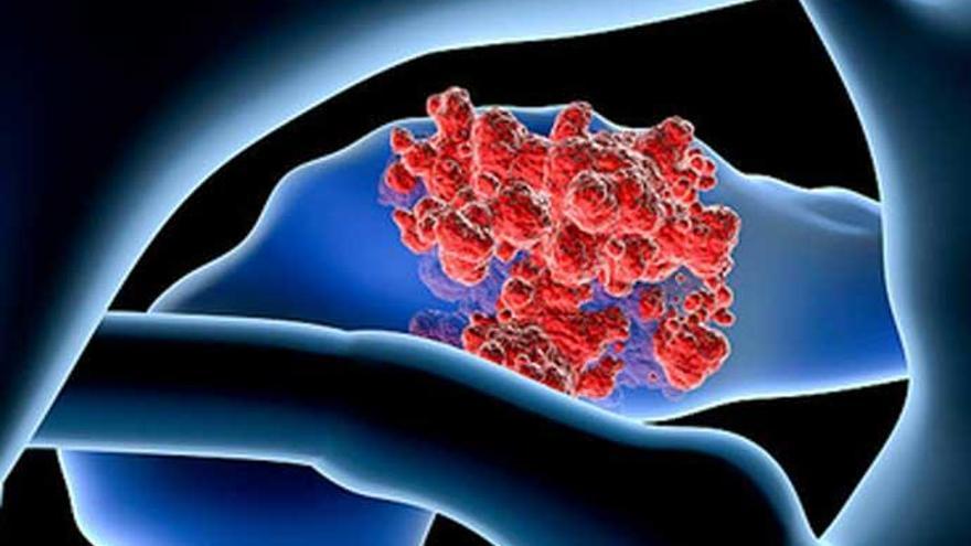 Ilustración que refleja la formación de un cáncer de páncreas.