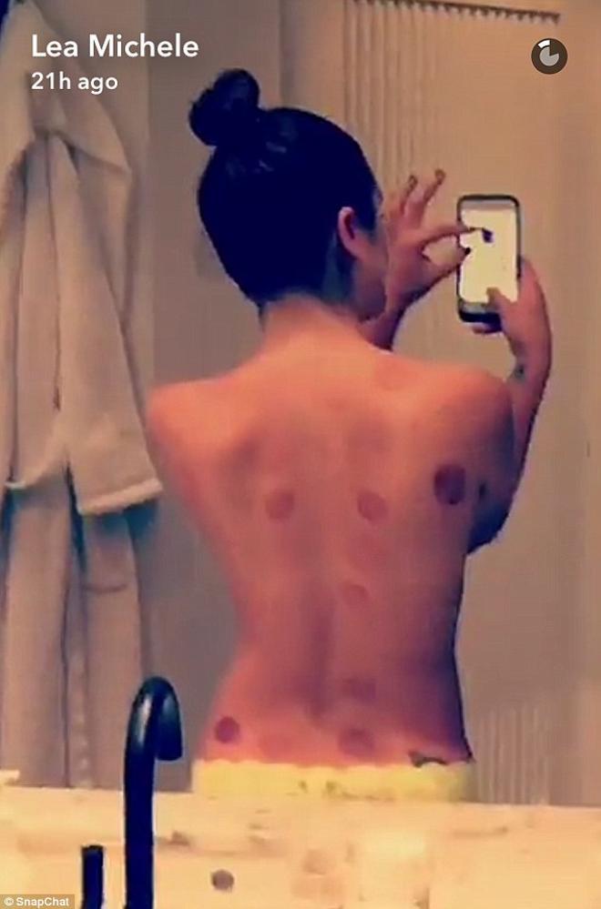 Lea Michele cupping