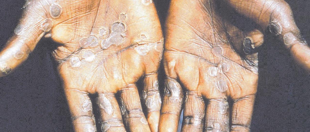 Un paciente afectado por la viruela del mono muestra las palmas de sus manos.