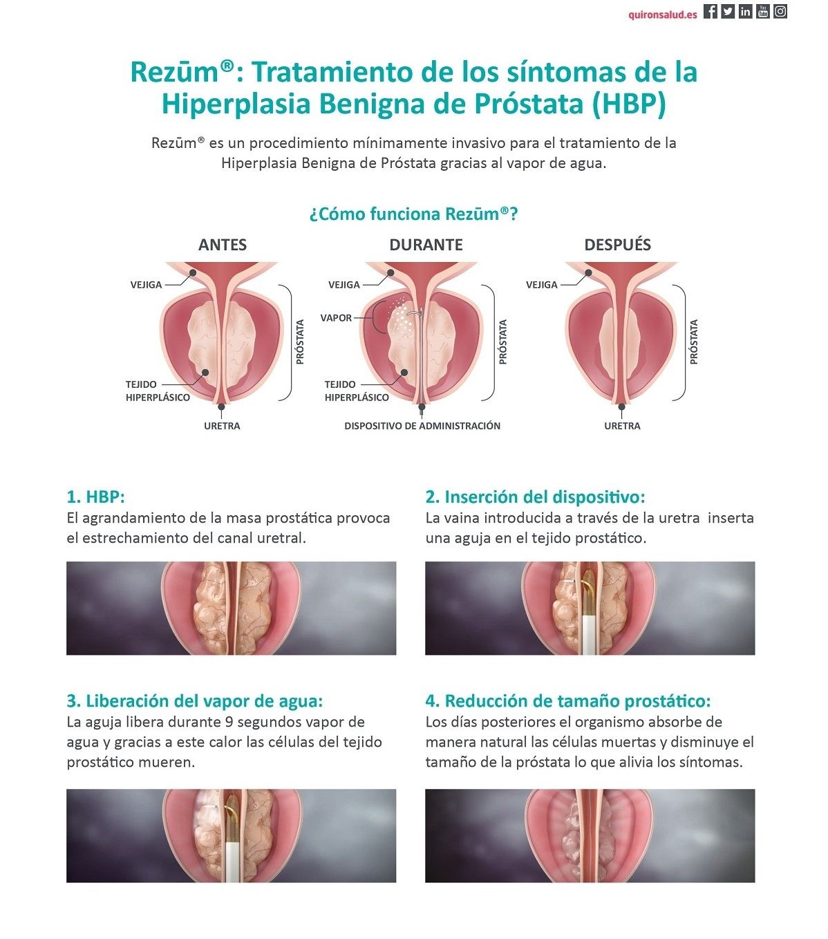 Infografía sobre el funcionamiento del Sistema Rezum aplicado en el Hospital Quirónsalud València.