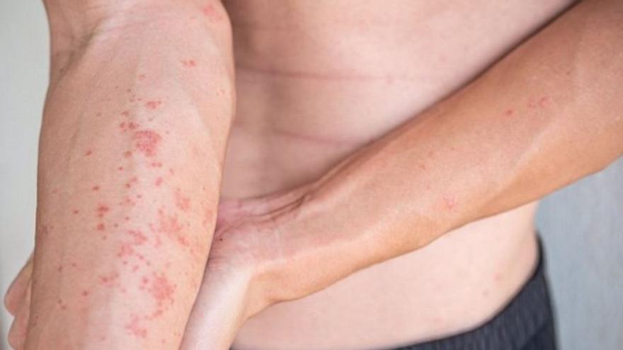 Quatre consells bàsics per a afrontar la dermatitis atòpica
