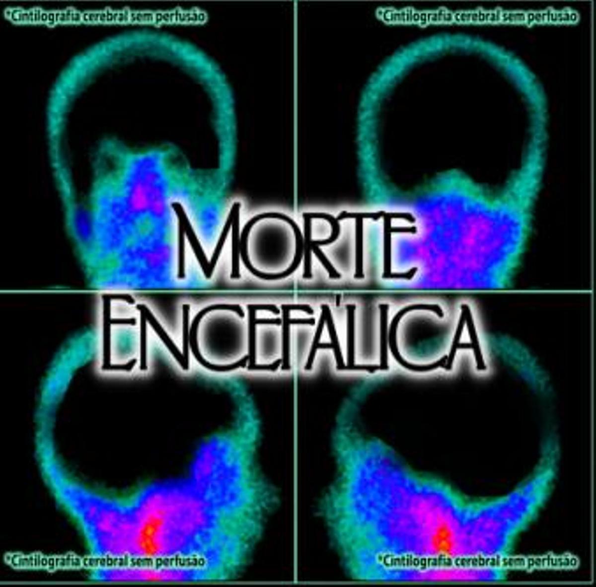 Morte Encecálica - Cintilografia