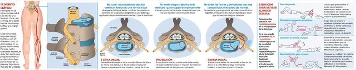 La ciática, una inflamación muy dolorosa