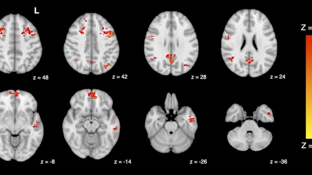 Una imagen por resonancia magnética funcional (fMRI) muestra disminución de la conectividad funcional en el cerebro después de la exposición a la contaminación del tráfico.