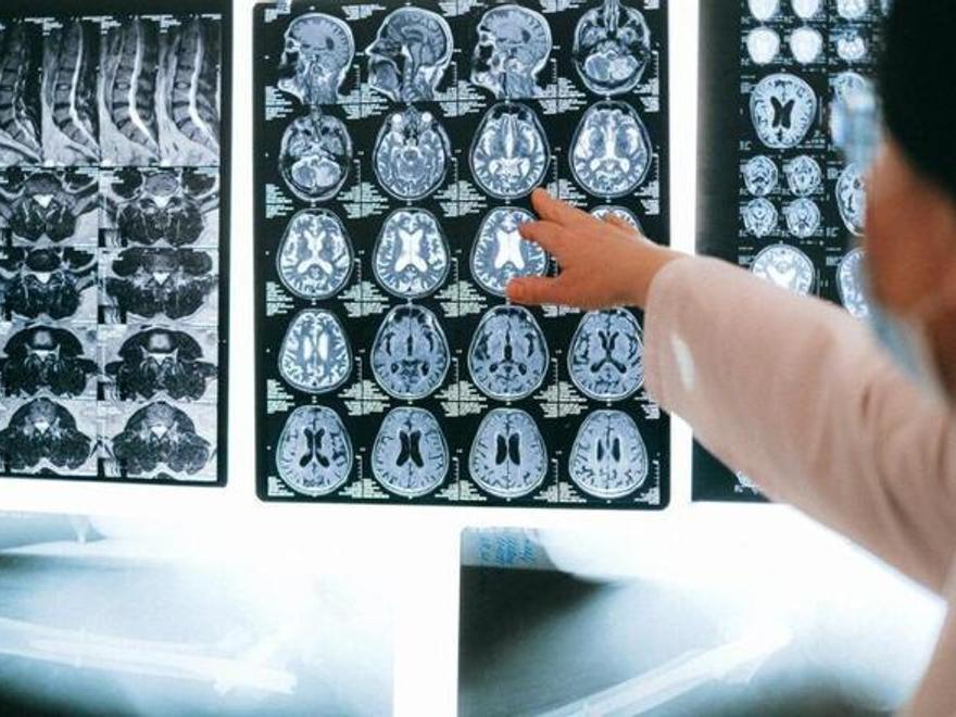 Evitar riscos d&#039;ictus i Alzheimer: els 7 consells dels neuròlegs per mantenir sa el cervell