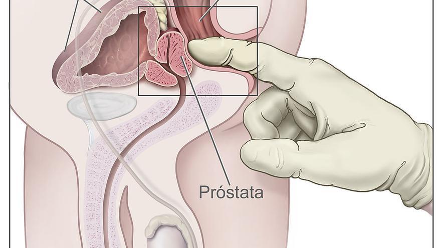 Ilustración médica para entender el tacto rectal como proueba para detectar el cáncer de próstata