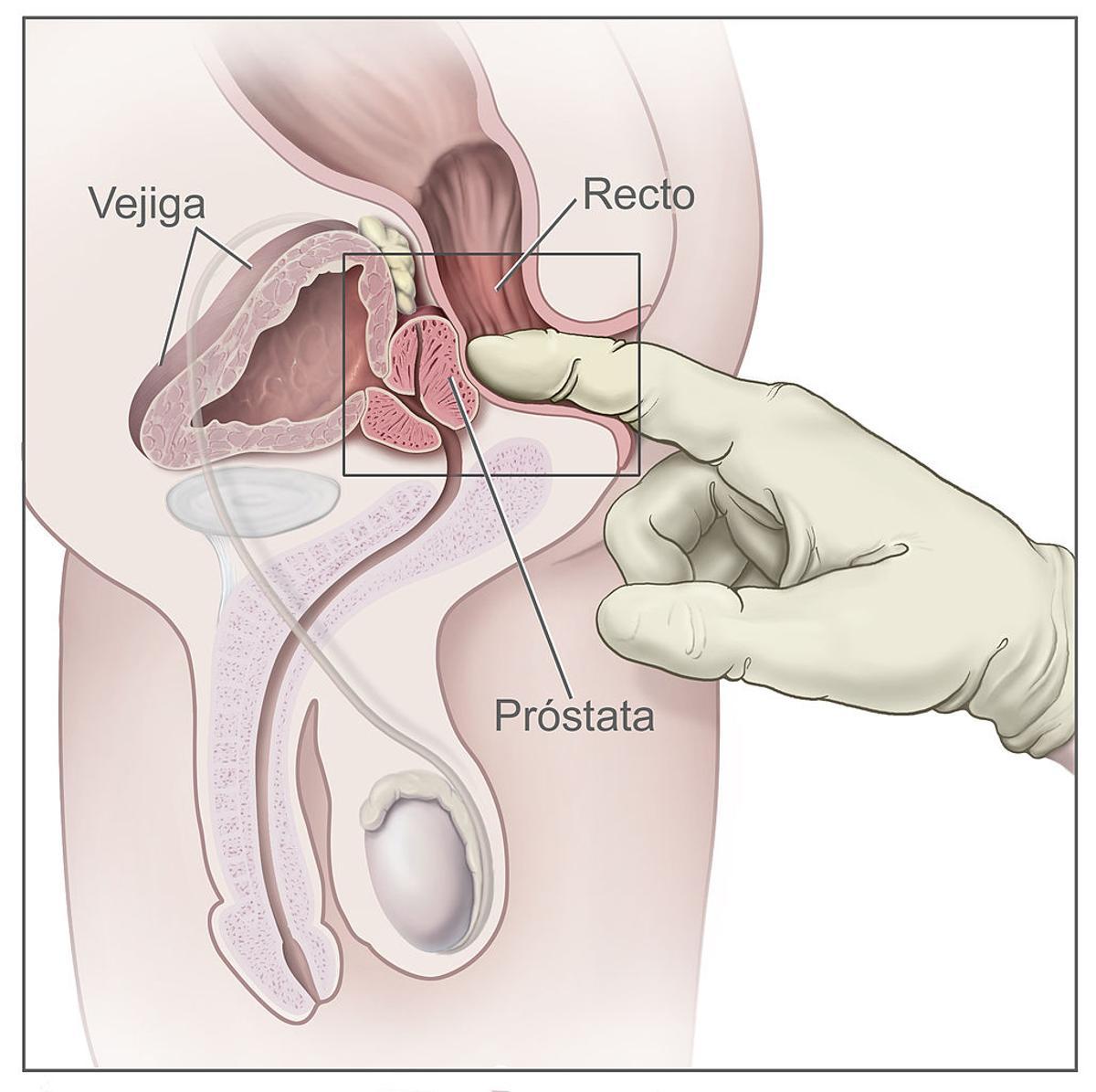 Ilustración médica para entender el tacto rectal como proueba para detectar el cáncer de próstata