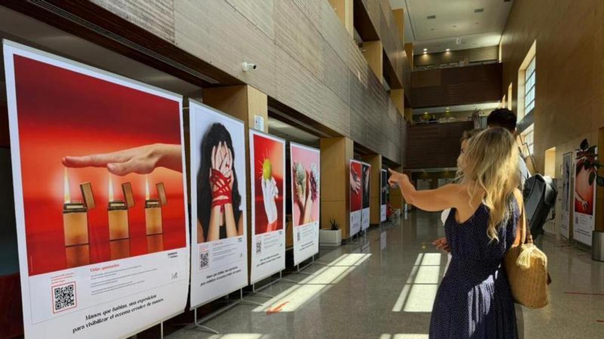La exposición muestra fotografías que reflejan lo que sienten los pacientes con eccema crónico de manos La exposición muestra fotografías que reflejan lo que sienten los pacientes con eccema crónico de manosGobierno de Aragón