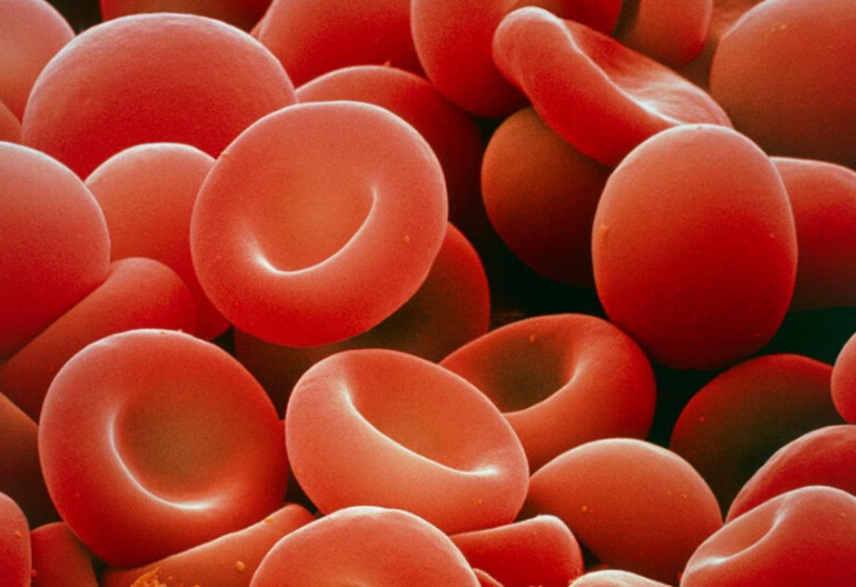 La talasemia es un trastorno sanguíneo hereditario caracterizado por una disminución de la producción de hemoglobina.