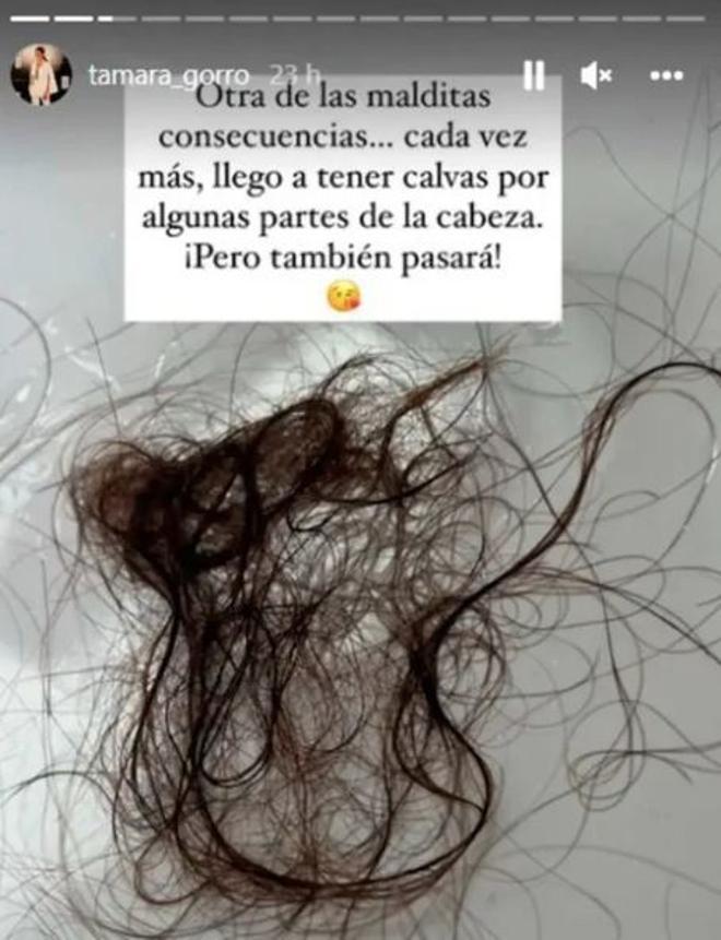 Instagram stories de Tamara Gorro con su pérdida de pelo
