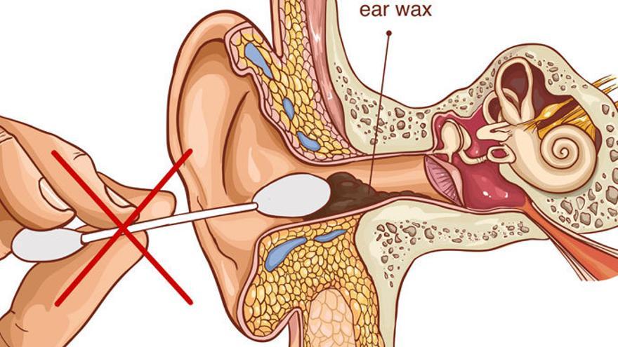 Un estudio reafirma la inconveniencia del uso de bastoncillos para los oídos
