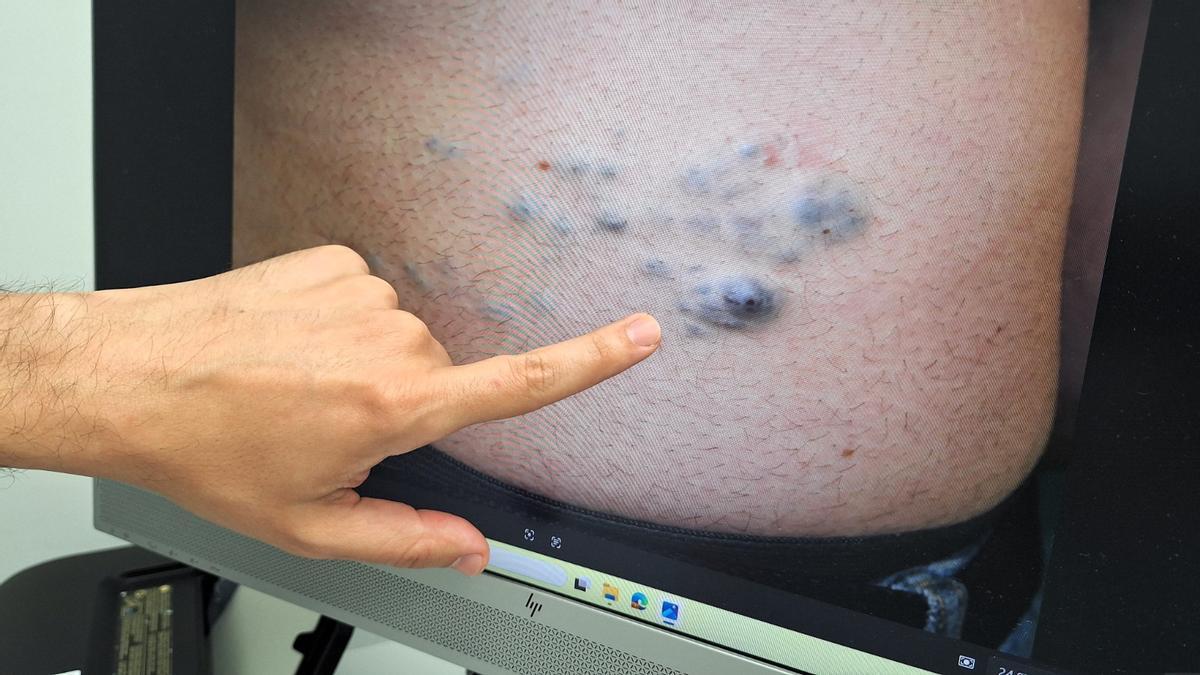 Un paciente con una malformación vascular en la espalda.