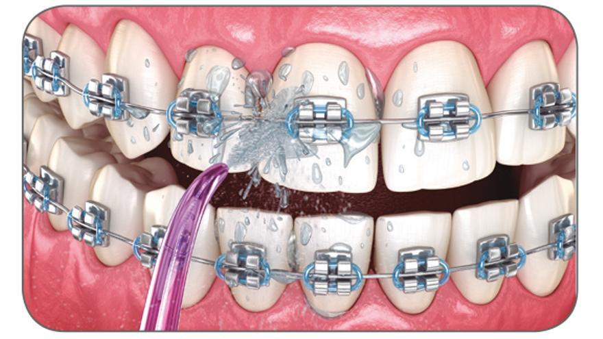 El uso de irrigador está muchas veces recomendado si se lleva ortodoncia, ya que puede facilitar el proceso de limpieza de los brackets. 