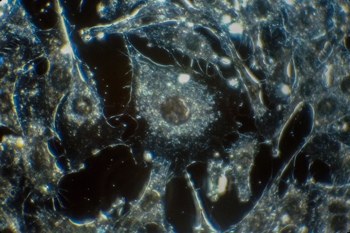 La metástasis es la principal causa de muerte por cáncer.