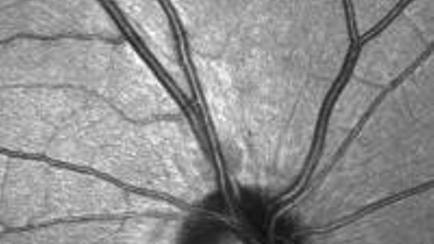Imagen de un nervio óptico registrada con un tomógrafo de coherencia.