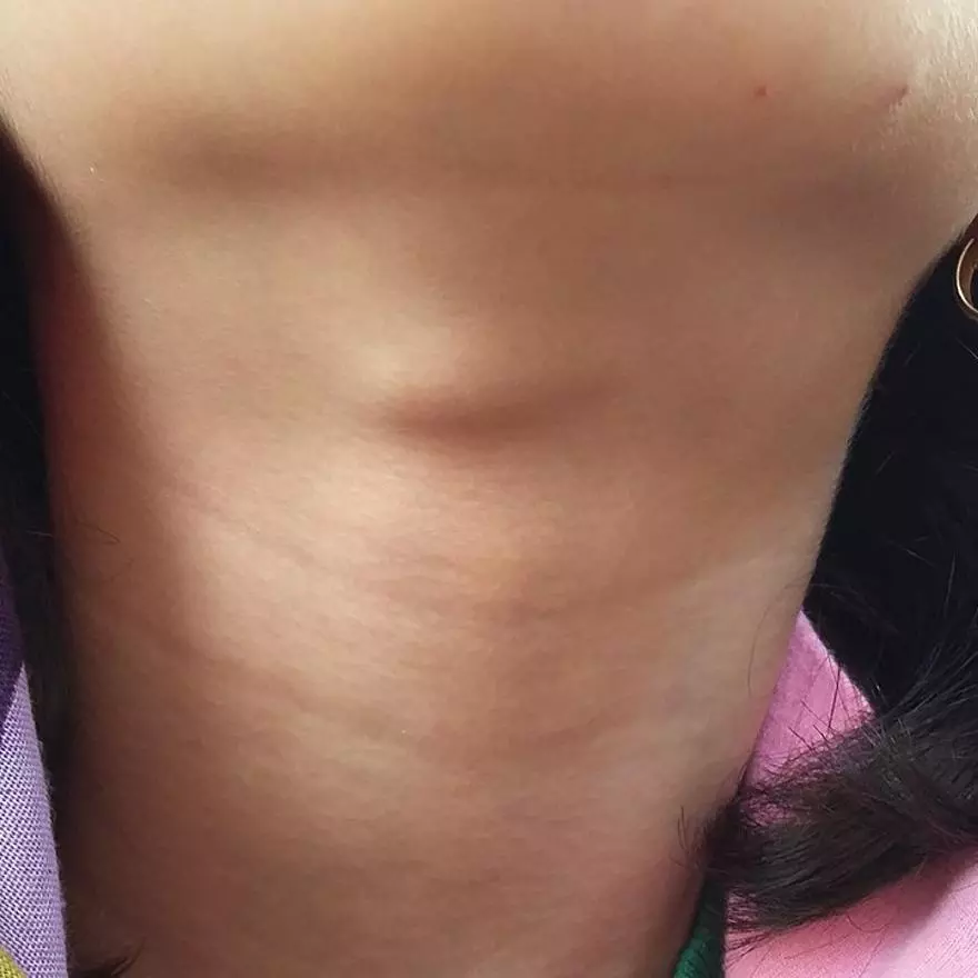 Causas beningnas de tumores en el cuello