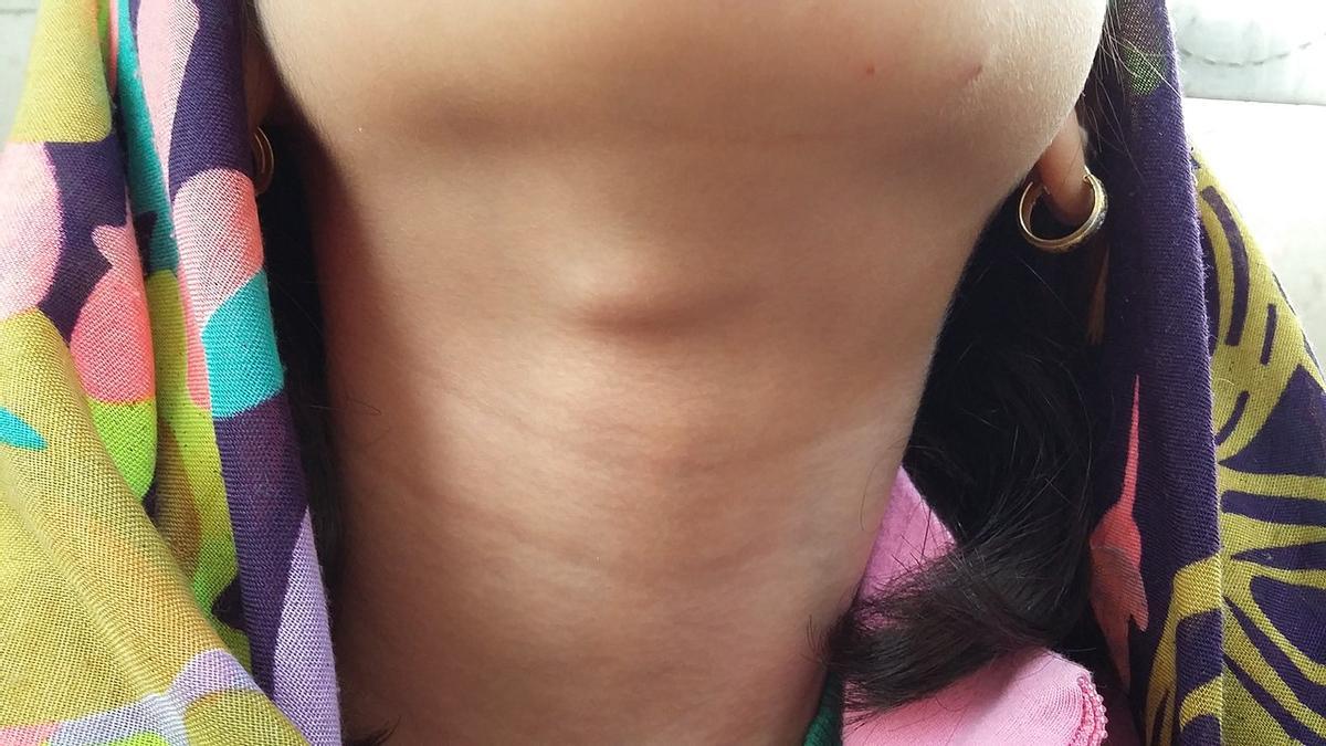 Imagen de una niña con un quiste tirogloso, que aunque podría ponernos en alerta no suele derivar en cancer de tiroides