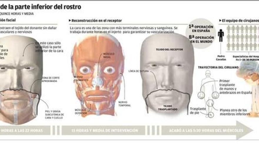 Gráfico del transplante de cara realizado por Pedro Cavadas.