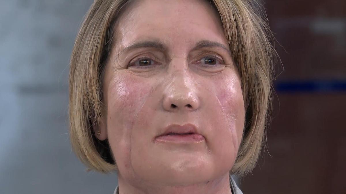 Hospital de Barcelona realiza histórico trasplante de cara con donante fallecida por eutanasia