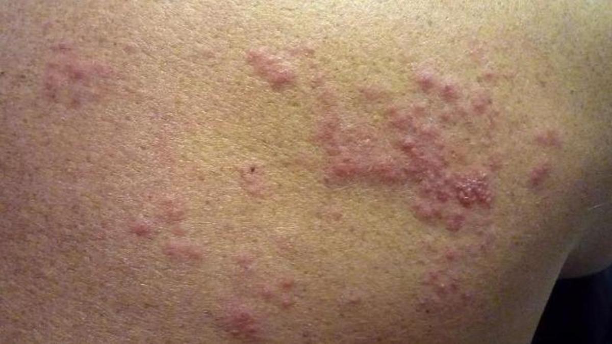 L'herpes zòster