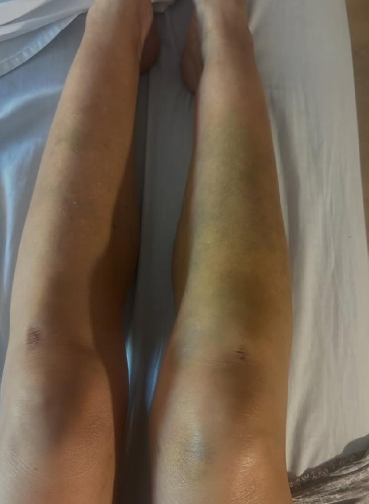Las piernas de Lydia Bosch tras su paso por el hospital
