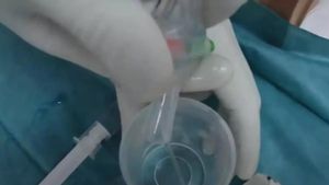 Detalle de la manipulación del catéter ideado por Rethink Medical.