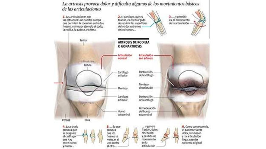 Implantes de células regeneradoras para la artrosis de rodilla, cadera o columna