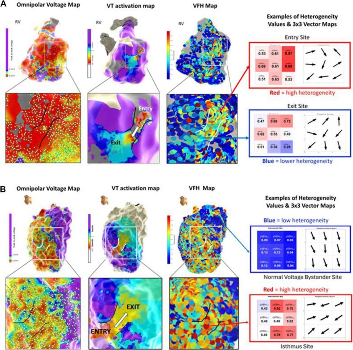Métrica Vector Field Heterogeneity (VFH), indicador diseñado para cuantificar las heterogeneidades de propagación local en las señales eléctricas del corazón.