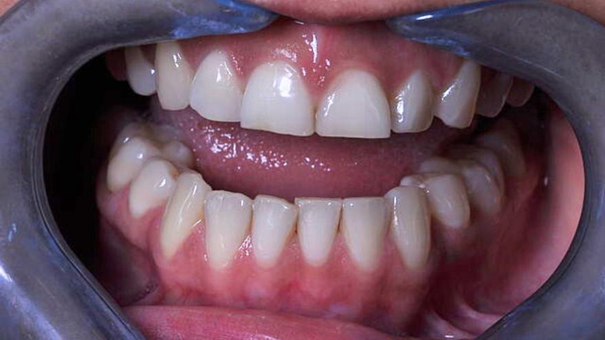 ¿Hay adultos con dientes de leche? Estas son las causas y las consecuencias de este problema poco conocido pero común