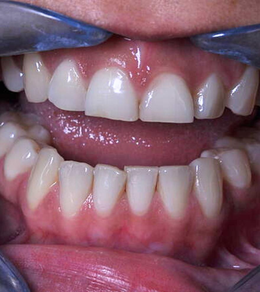 ¿Hay adultos con dientes de leche? Estas son las causas y las consecuencias de este problema poco conocido pero común