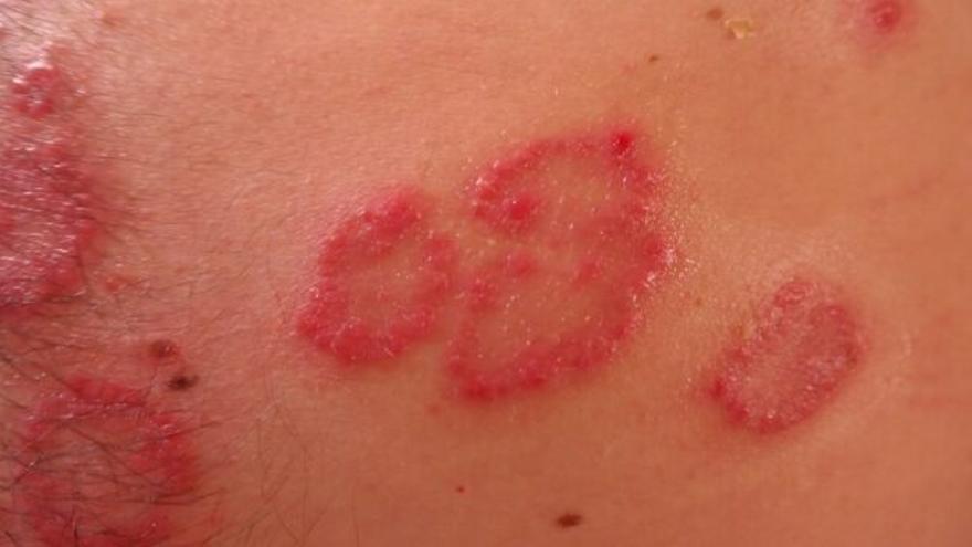 Qué es la psoriasis y cómo podemos evitar el picor