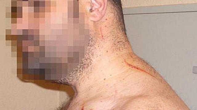 Arañazos en el cuello y un mordisco en la mano de la víctima tras la agresión.
