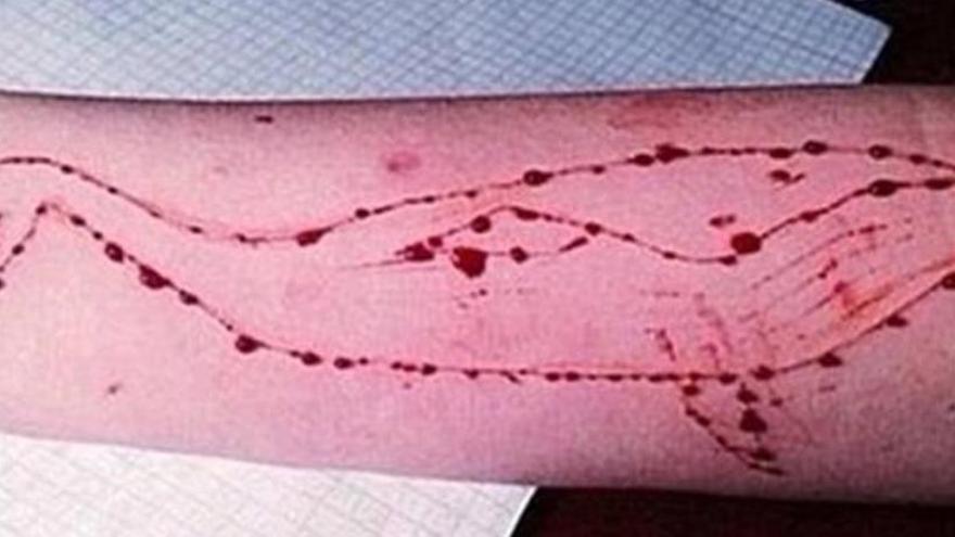 Heridas en el brazo de una joven que se &#039;tatuó&#039; la silueta de una ballena, jugando a la macabra moda.