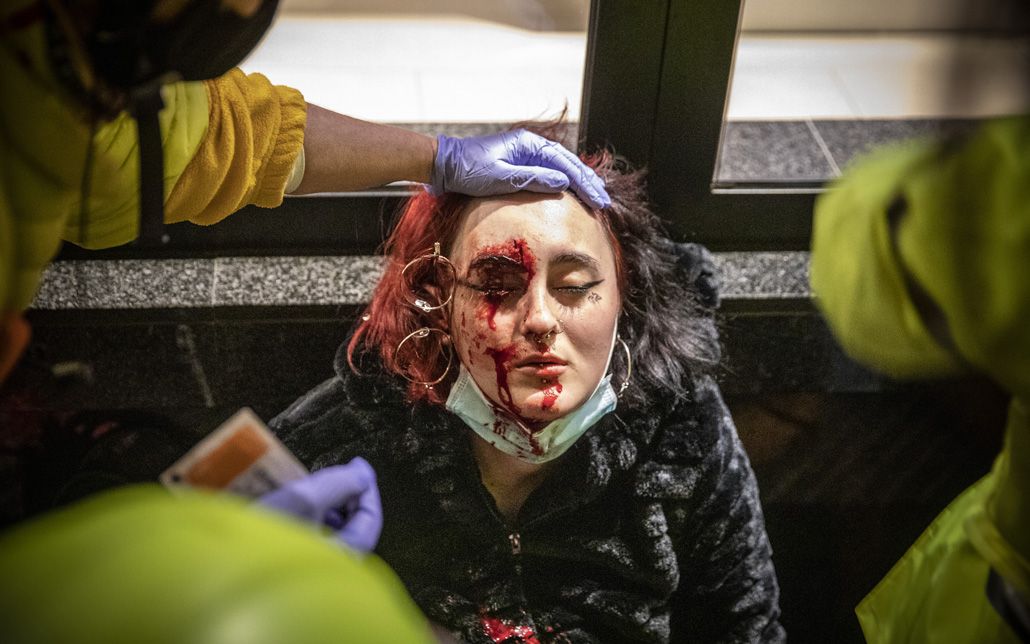 Barcelona 16/02/2021 Mujer herida en el ojo por el disparo de una bala de foam de los Mossos d’Esquadra durante los disturbios en la manifestación por las protestas del encarcelamiento del rapero Pablo Hasél  FOTO de FERRAN NADEU