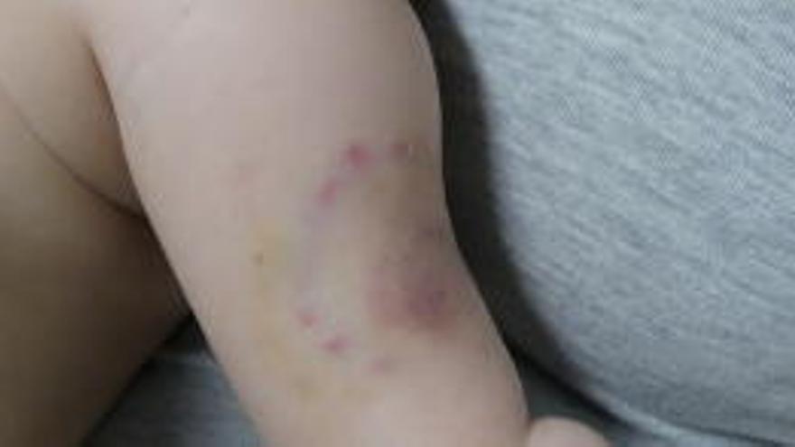 Das zwei Monate alte Kind hatte Biss-Spuren am Arm