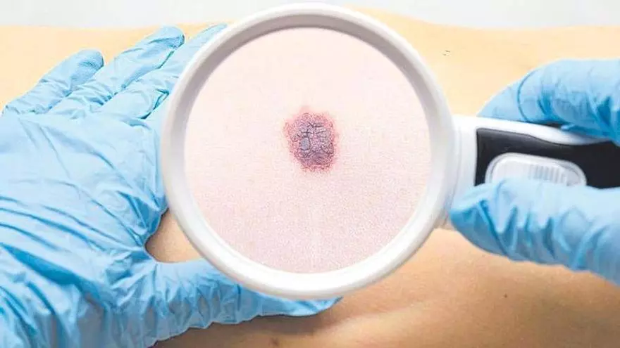 Un estudio en fase 3 demuestra resultados prometedores en la vacuna contra el melanoma, el cáncer de piel más agresivo