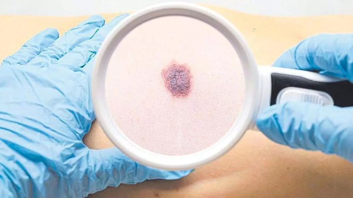 Un estudio en fase 3 demuestra resultados prometedores en la vacuna contra el melanoma