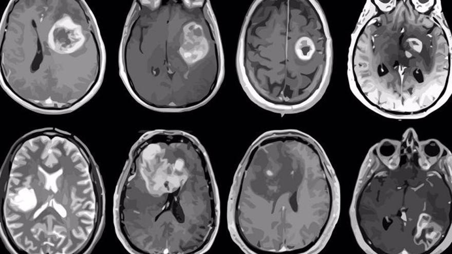 Descubren una terapia combinada que podría mejorar la supervivencia de los pacientes con tumores cerebrales agresivos