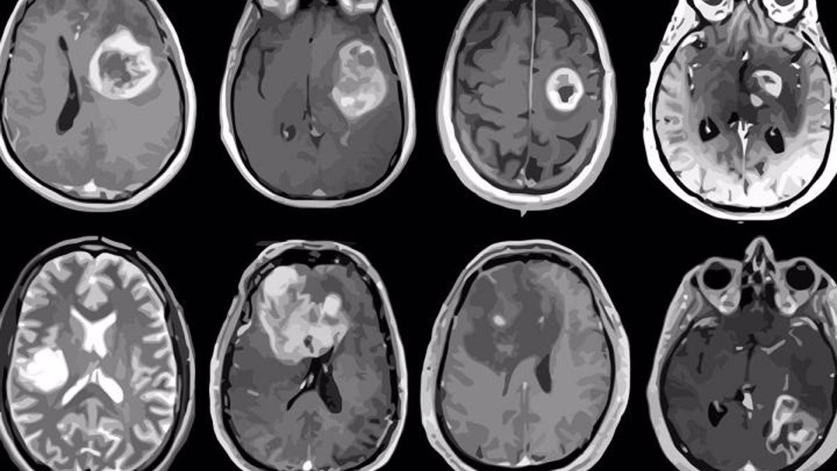 Glioblastoma, tumor cerebral agresivo mapeado en detalle genético y molecular