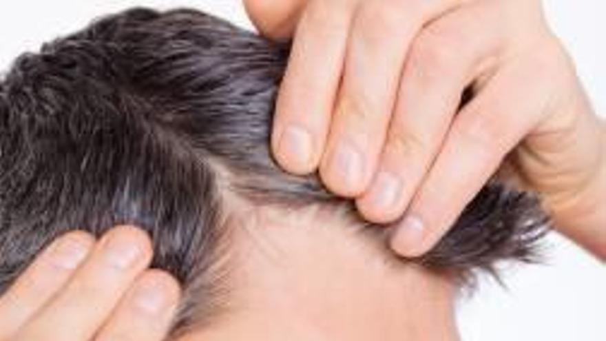 Alopecia masculina, ¿es una enfermedad?