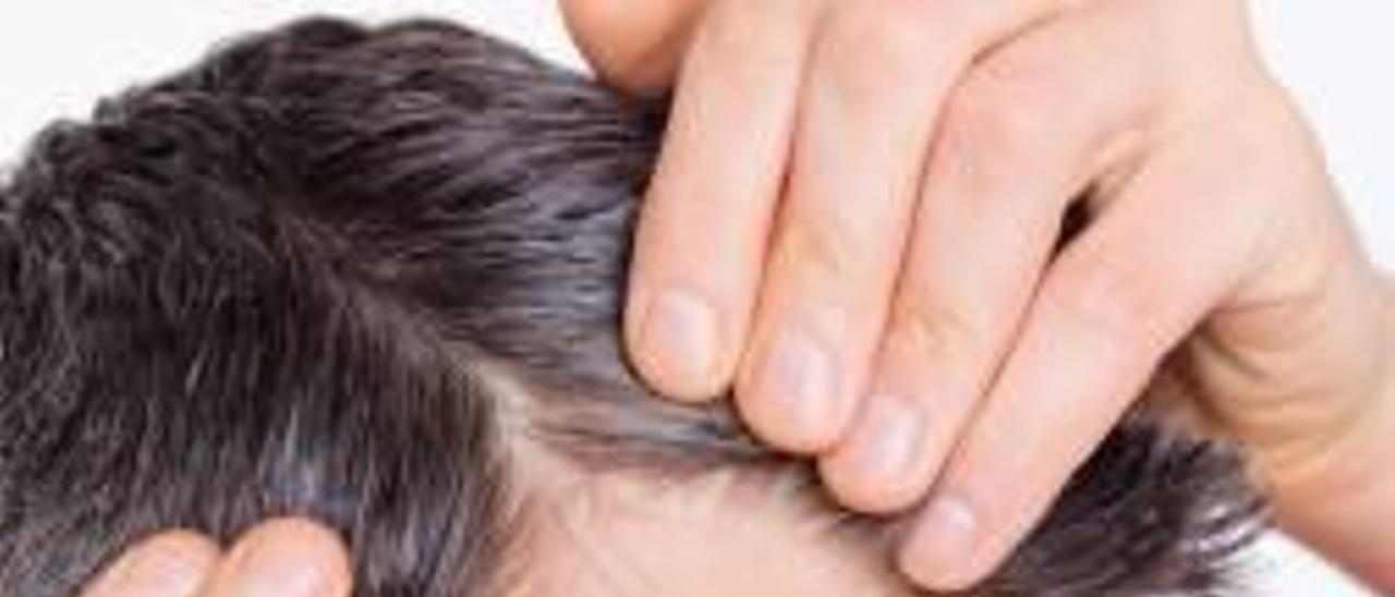 Alopecia masculina, ¿es una enfermedad?