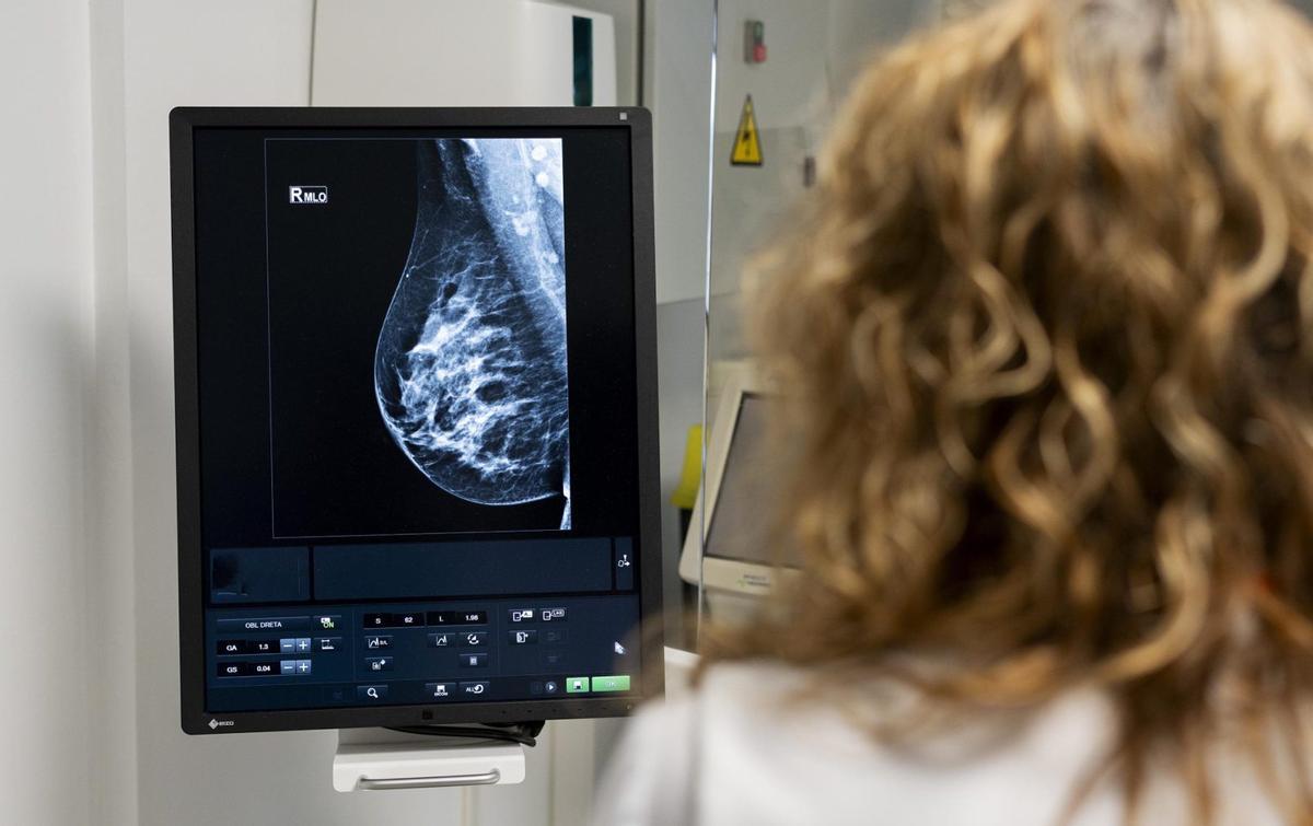 La IA detecta un 30% més de càncers de mama i tumors més avançats